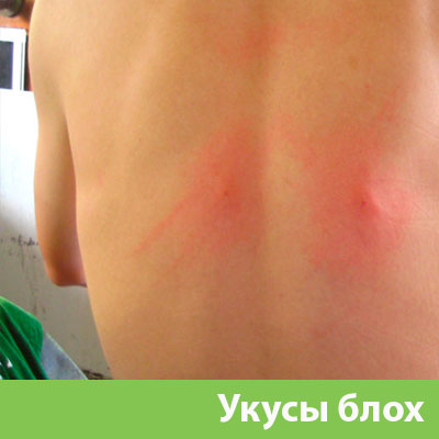 Укусы блох в Новороссийске