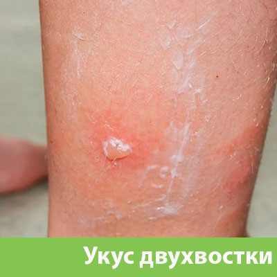 Укус двухвостки в Новороссийске