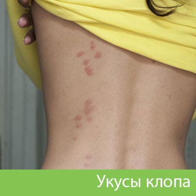 Профессиональное уничтожение клопов в Новороссийске